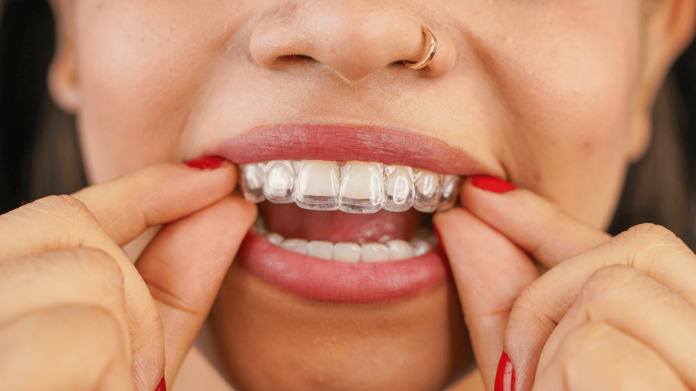 Alinhador transparente ajustado aos dentes