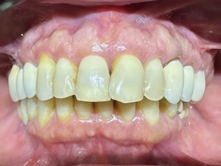 Registro intraoral frontal