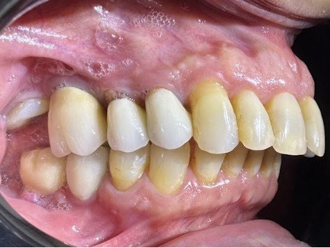 Registro intraoral lateral direito