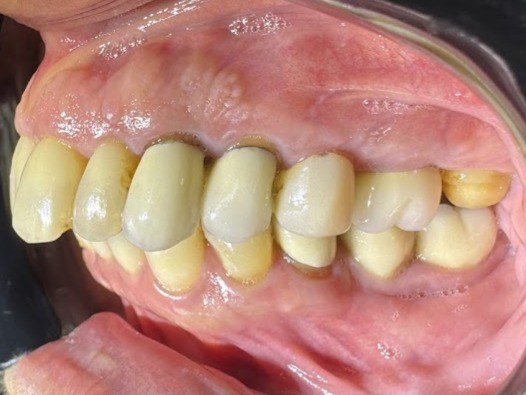 Registro intraoral do lado esquerdo antes do tratamento