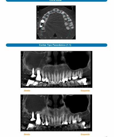 Cortes tomográficos anonimizados da arcada superior