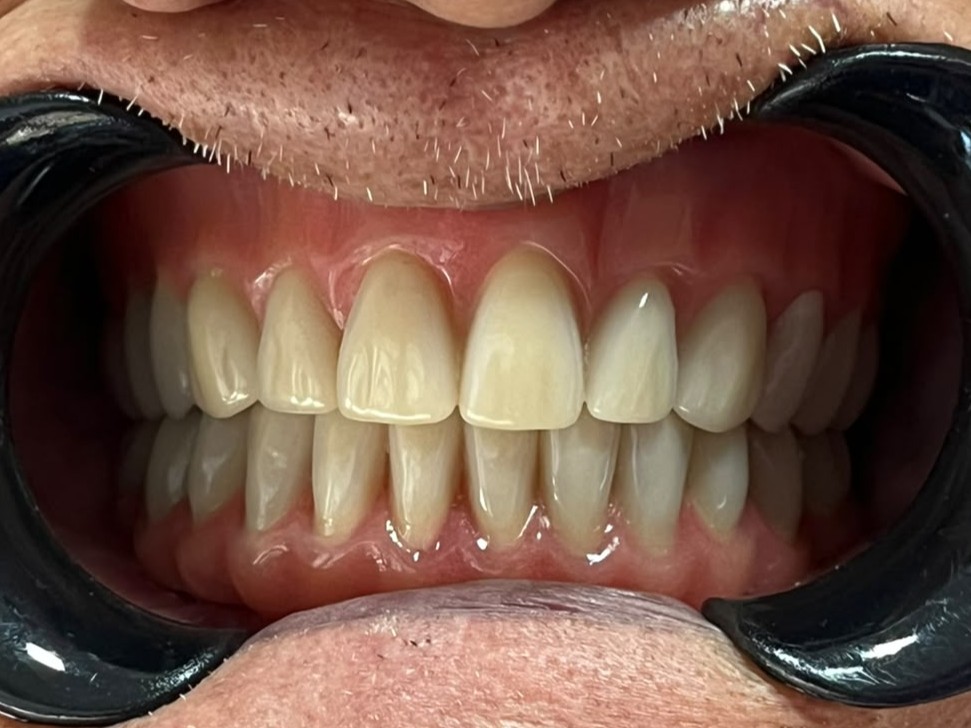 Resultado intraoral — Vista frontal
