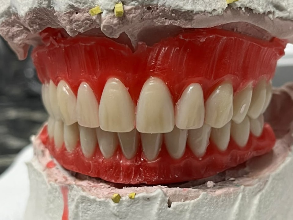 Montagem das próteses em modelo no laboratório