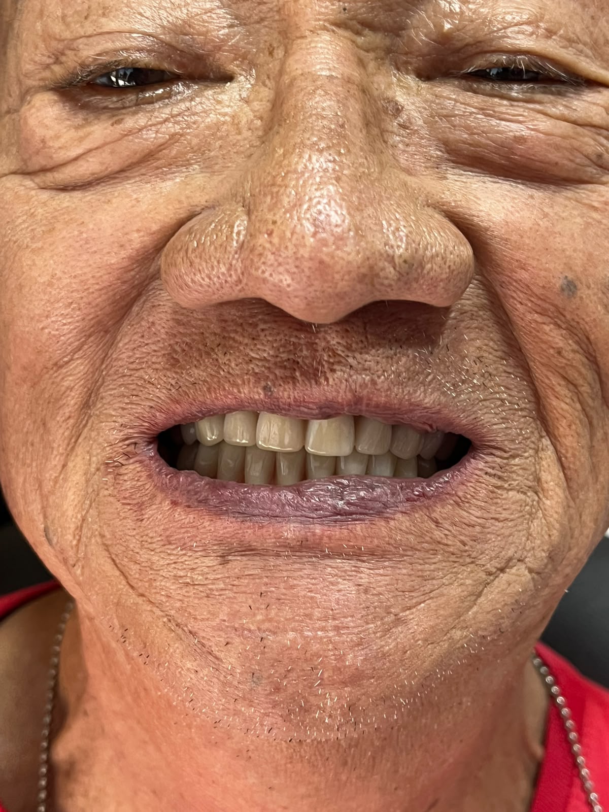 Sorriso do paciente após a entrega das próteses